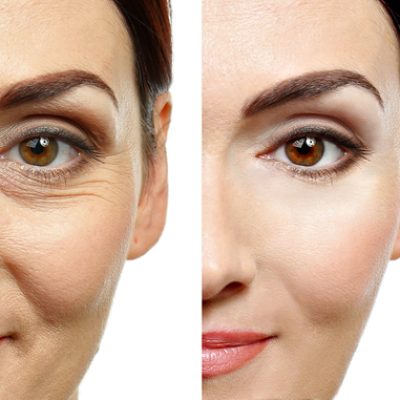 Woman,Face,Before,And,After,Cosmetic,Procedure.,Plastic,Surgery,Concept.